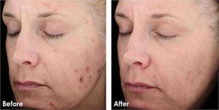 Skin-Medica-Chemical-Peel-2A